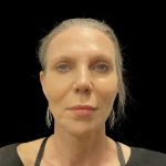 Facelift Before & After Patient #6489