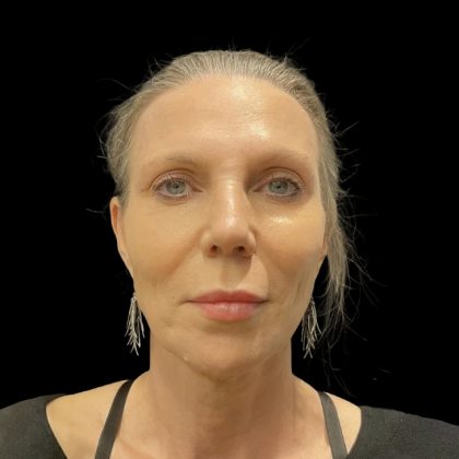 Facelift Before & After Patient #6489