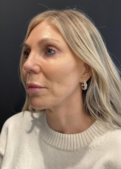 Facelift Before & After Patient #6489
