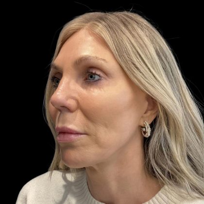 Facelift Before & After Patient #6489