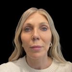 Facelift Before & After Patient #6489