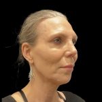 Facelift Before & After Patient #6489