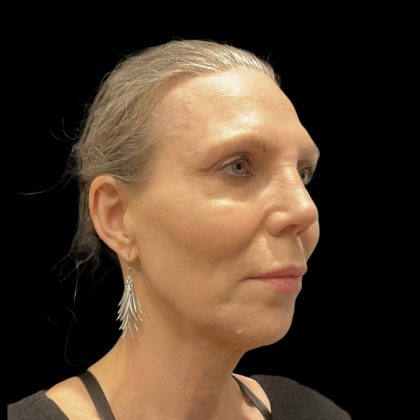 Facelift Before & After Patient #6489