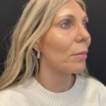 Facelift Before & After Patient #6489
