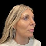 Facelift Before & After Patient #6489