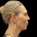 Facelift Before & After Patient #6489