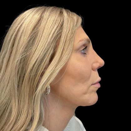 Facelift Before & After Patient #6489