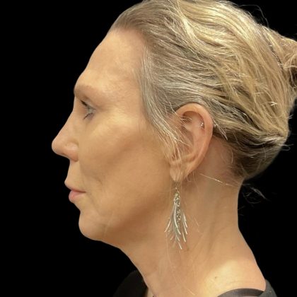 Facelift Before & After Patient #6489