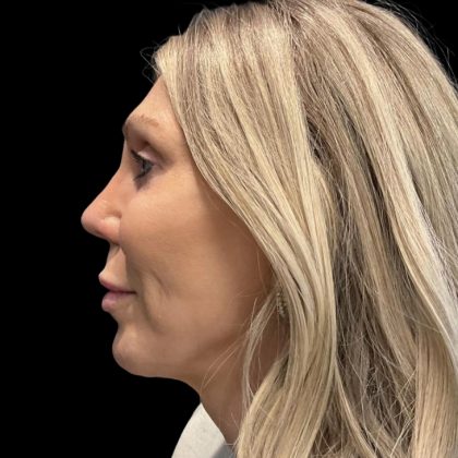 Facelift Before & After Patient #6489