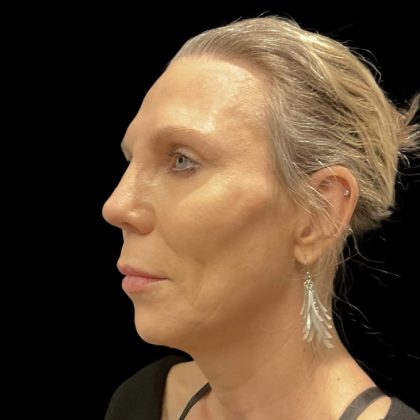 Facelift Before & After Patient #6489