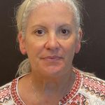 Facelift Before & After Patient #6490