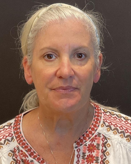 Facelift Before & After Patient #6490