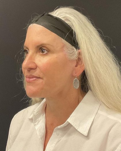 Facelift Before & After Patient #6490