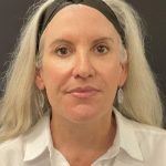 Facelift Before & After Patient #6490