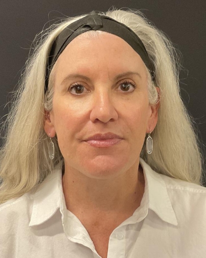 Facelift Before & After Patient #6490