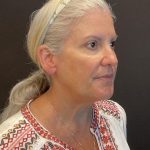 Facelift Before & After Patient #6490