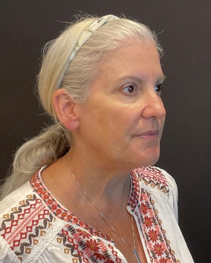 Facelift Before & After Patient #6490