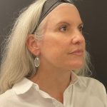 Facelift Before & After Patient #6490