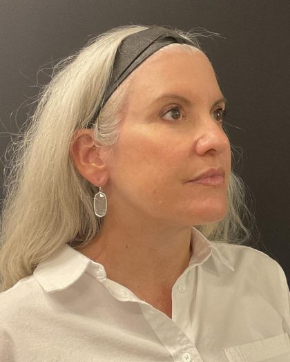 Facelift Before & After Patient #6490
