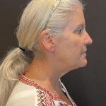 Facelift Before & After Patient #6490