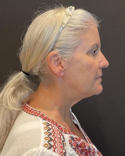 Facelift Before & After Patient #6490