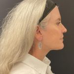 Facelift Before & After Patient #6490