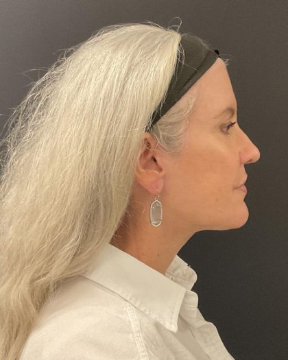 Facelift Before & After Patient #6490