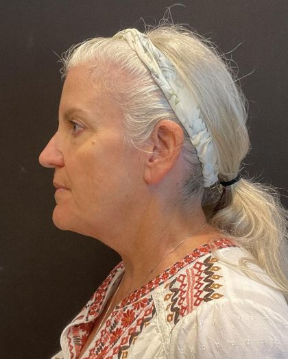 Facelift Before & After Patient #6490
