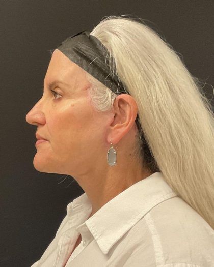 Facelift Before & After Patient #6490