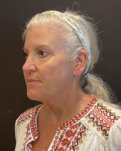 Facelift Before & After Patient #6490
