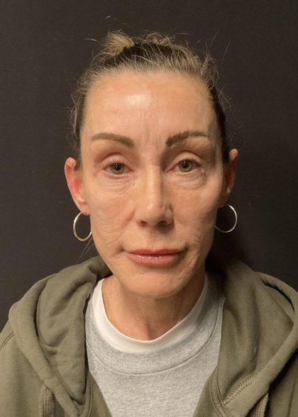 Facelift Before & After Patient #6492