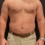 High Definition Liposuction Before & After Patient #6722