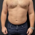 High Definition Liposuction Before & After Patient #6722