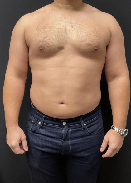 High Definition Liposuction Before & After Patient #6722