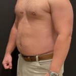 High Definition Liposuction Before & After Patient #6722