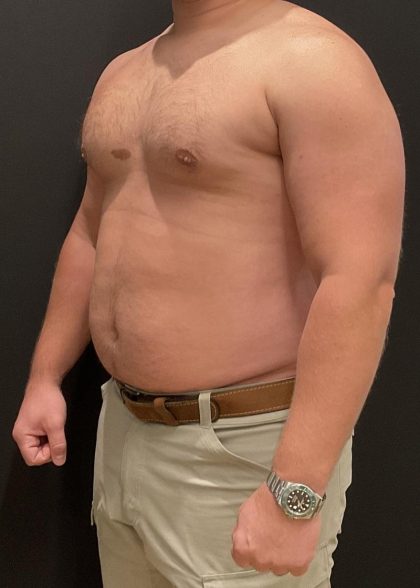 High Definition Liposuction Before & After Patient #6722