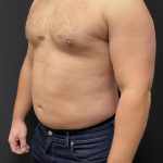 High Definition Liposuction Before & After Patient #6722