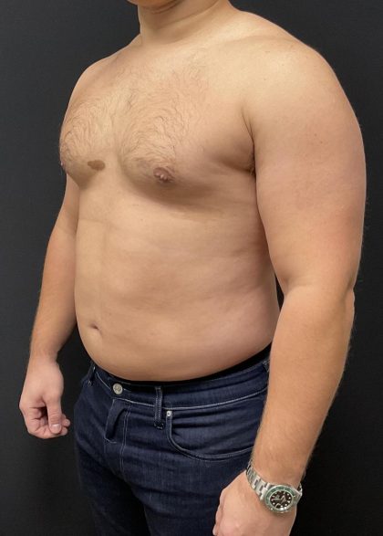 High Definition Liposuction Before & After Patient #6722