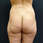 Butt Implants Before & After Patient #6841