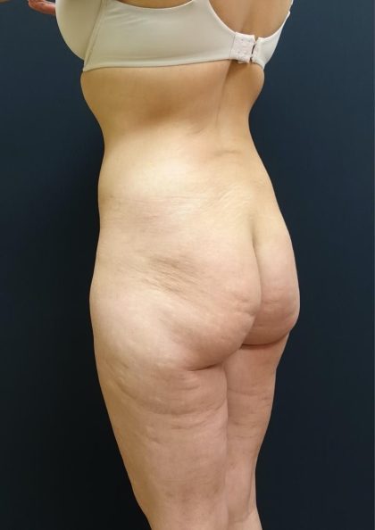 Butt Implants Before & After Patient #6841