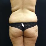 Butt Implants Before & After Patient #6842