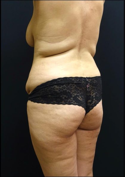 Butt Implants Before & After Patient #6842