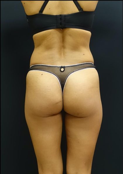 Butt Implants Before & After Patient #6844