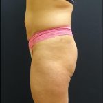 Butt Implants Before & After Patient #6845