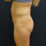 Butt Implants Before & After Patient #6845