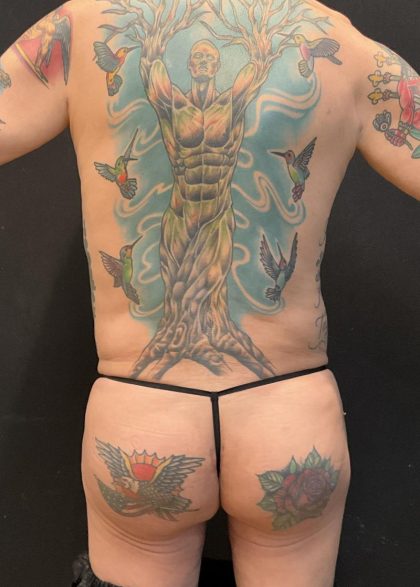 Butt Implants Before & After Patient #6846