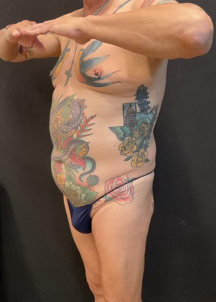 Butt Implants Before & After Patient #6846
