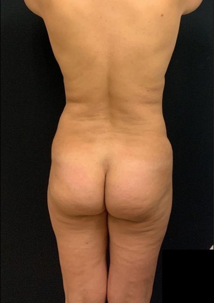 Liposuction Before & After Patient #6947