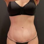 Liposuction Before & After Patient #6948
