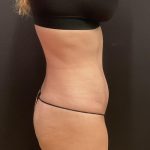 Liposuction Before & After Patient #6948